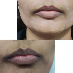 Permanent Lip Coloring in Punjabi Bagh