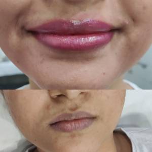 Permanent Lip Coloring in Punjabi Bagh