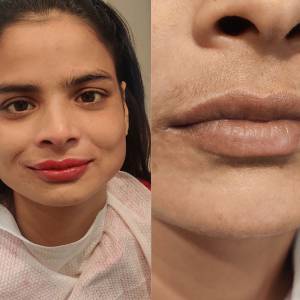 Permanent Lip Coloring in Punjabi Bagh